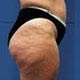le stade de la cellulite