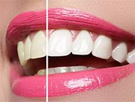 blanchiment des dents
