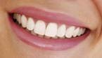 blanchiment des dents